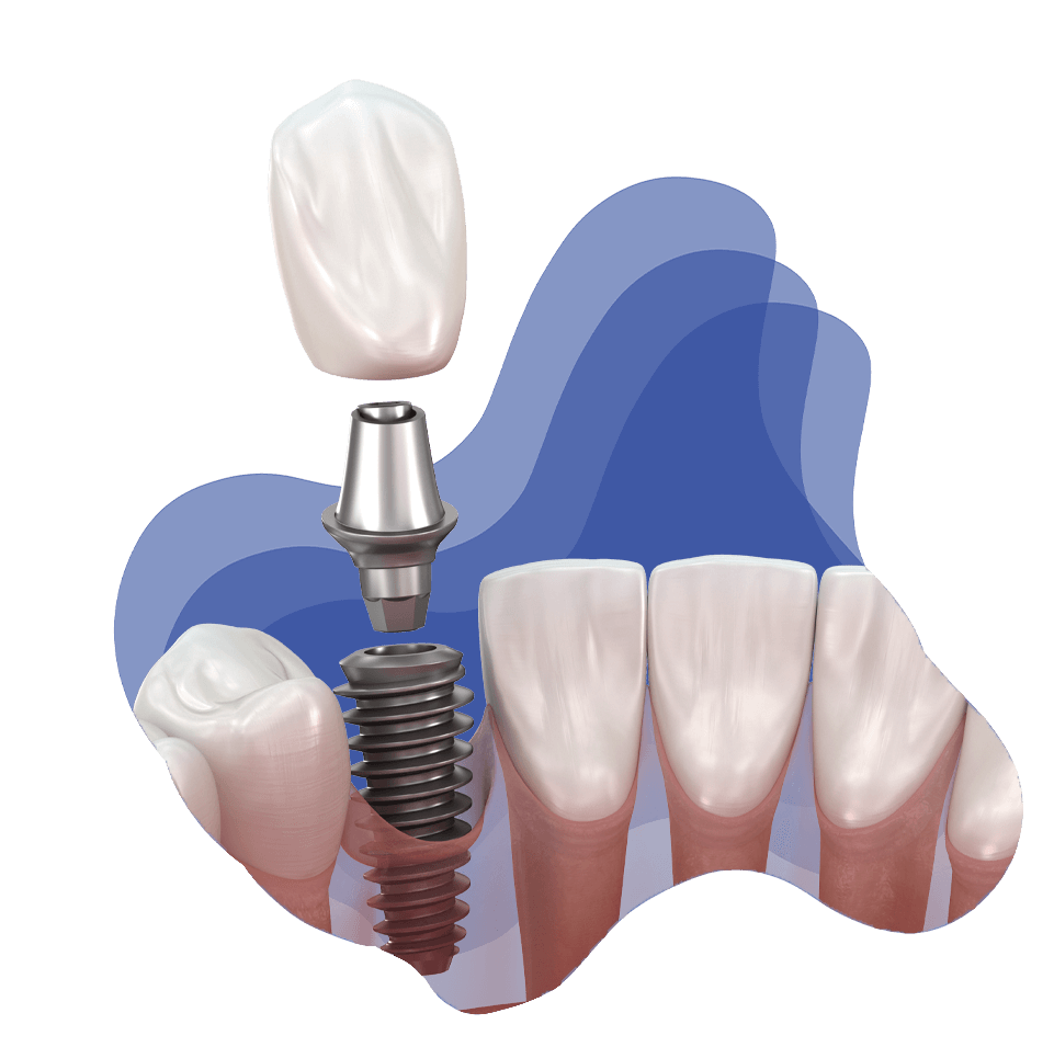 dental implant model