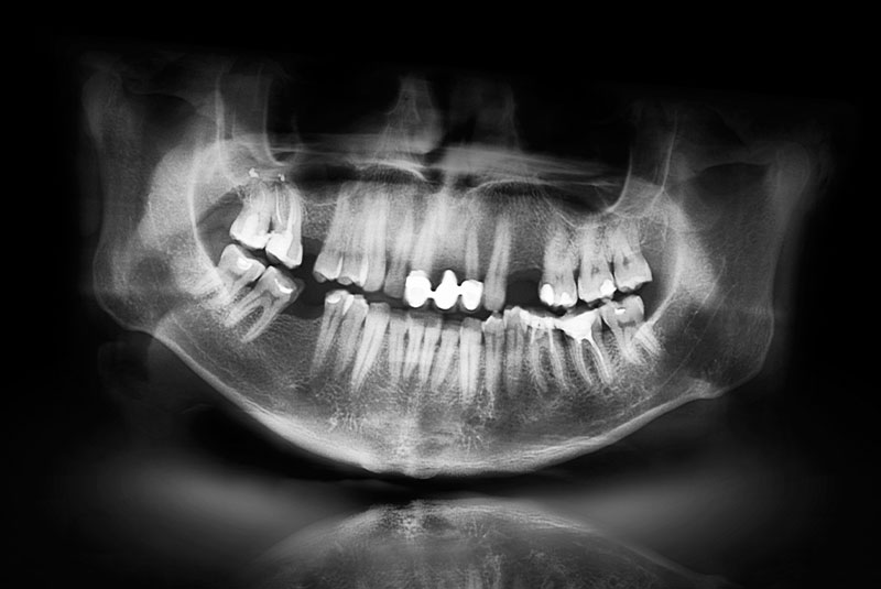 missing teeth on xray